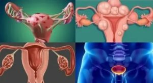 Цимицифуга при миоме и эндометриозе