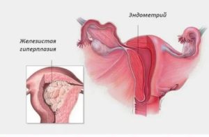 Эндометриоз и гиперплазия матки это одно заболевание или нет