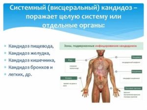 Висцеральный кандидоз симптомы лечение
