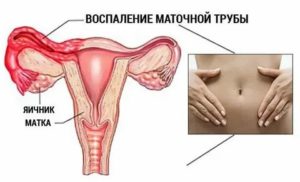 Может ли быть задержка месячных после воспаления яичников