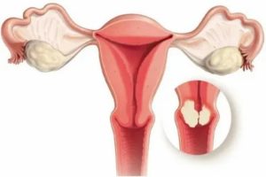 Рак матки первые признаки и симптомы в пожилом возрасте