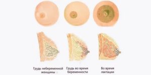 Может ли перед месячными одна грудь быть больше другой