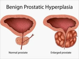 Гипертрофия простаты лечение народными средствами
