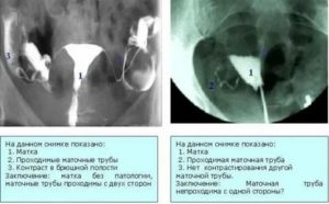 Подготовка к проверке маточных труб на проходимость по узи