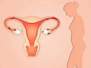 Коричневые выделения эндометриоз тела матки
