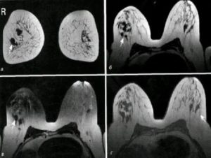 Мрт диагностика фиброаденомы молочной железы