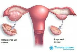 Что такое киста яичника и от чего она появляется у девочки