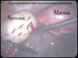 Что такое поликистоз яичников проходит после родов