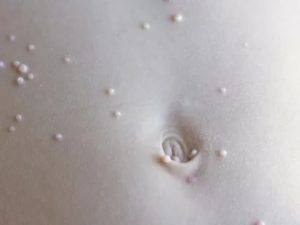 Лечение кандидозного моллюска у детей народными средствами