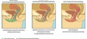 Запах мочи во время климакса