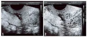 Эндометриоз послеоперационного рубца передней брюшной стенки операция