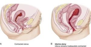Как заставить сокращаться матку во время месячных