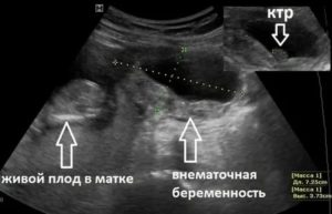 Как исключить внематочную беременность на ранних сроках без узи