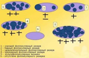 Определение овариального резерва яичников узи