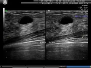 Как выглядит саркома молочной железы на узи