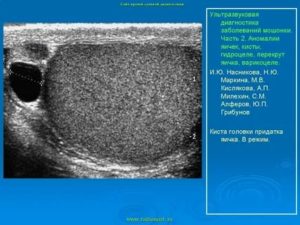 Нормальные размеры придатка яичка на узи