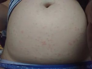 Может быть сыпь перед месячными по всему телу