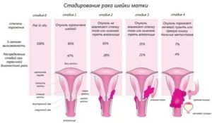 Рак культи шейки матки симптомы и