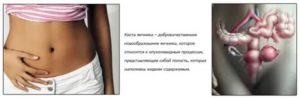 Можно ли делать массаж спины при кисте яичников