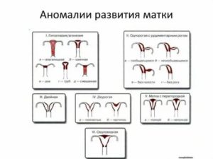 Пороки развития матки методы диагностики