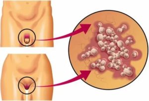 Впч и хроническая молочница