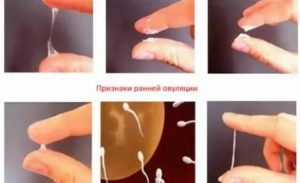 Может ли быть молочница в первые дни зачатия