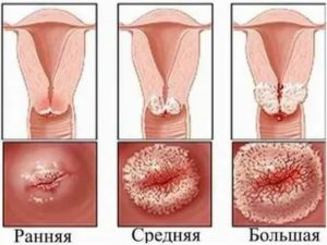 Чем лечить кандидоз шейки матки