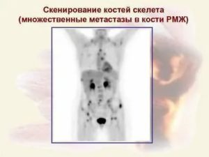 Продолжительность жизни при метастазах в костях при раке молочной железы