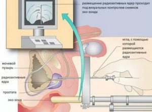 Брахитерапия рака предстательной железы отзывы последствия