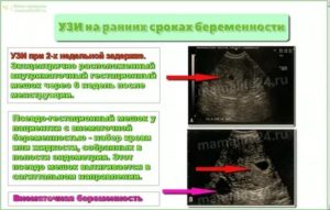 Как исключить внематочную беременность на ранних сроках без узи