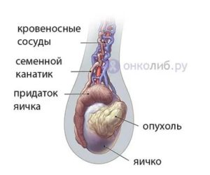 Опухоль как третье яичко что это может быть