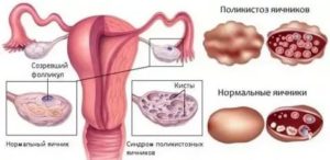 Когда начнутся месячные после дриллинга яичников