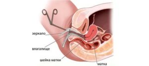 Диагностика влагалища с биопсией