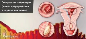 Эндометриоз и гиперплазия матки это одно заболевание или нет