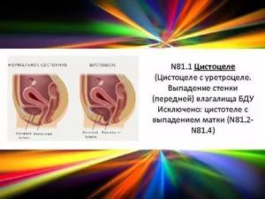 Препараты для лечения цистоцеле