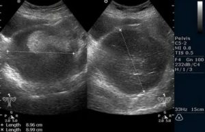 Как по узи выглядит тератома яичника на узи