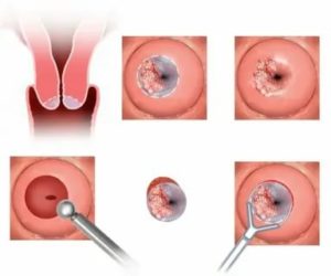Что такое эрозия шейки матки перед месячными