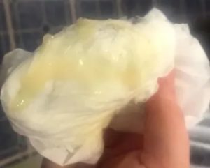 Могут ли быть при климаксе зеленоватые выделения