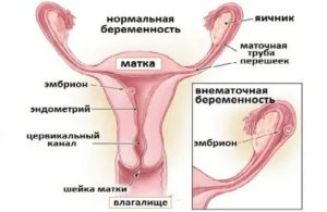 Могут ли не идти месячные при внематочной беременности на ранних сроках