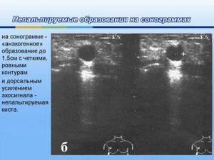 При узи молочных желез обнаружили множество анэхогенных образований