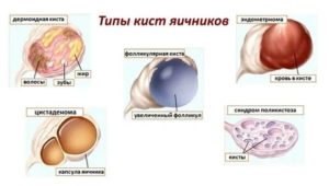 Что такое трехкамерная киста правого яичника
