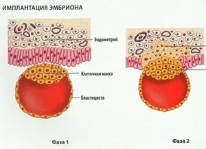 Может ли поздняя имплантация совпасть с месячными