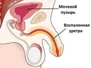 Может ли из-за антибиотиков быть боль в уретре