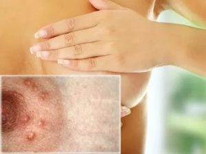 Могут ли болеть молочные железы при молочнице