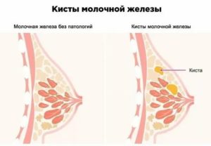 Почему увеличиваются грудные железы при климаксе