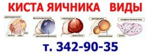 Что такое параовариальная киста яичника во время беременности