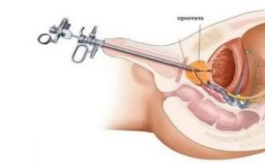 Биопсия предстательной железы тур-биопсия предстательной железы