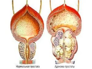 Что такое калькулез предстательной железы