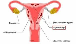 Как вести себя во время месячных при эндометриозе