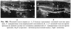 Что такое узи кавернозных тел полового члена